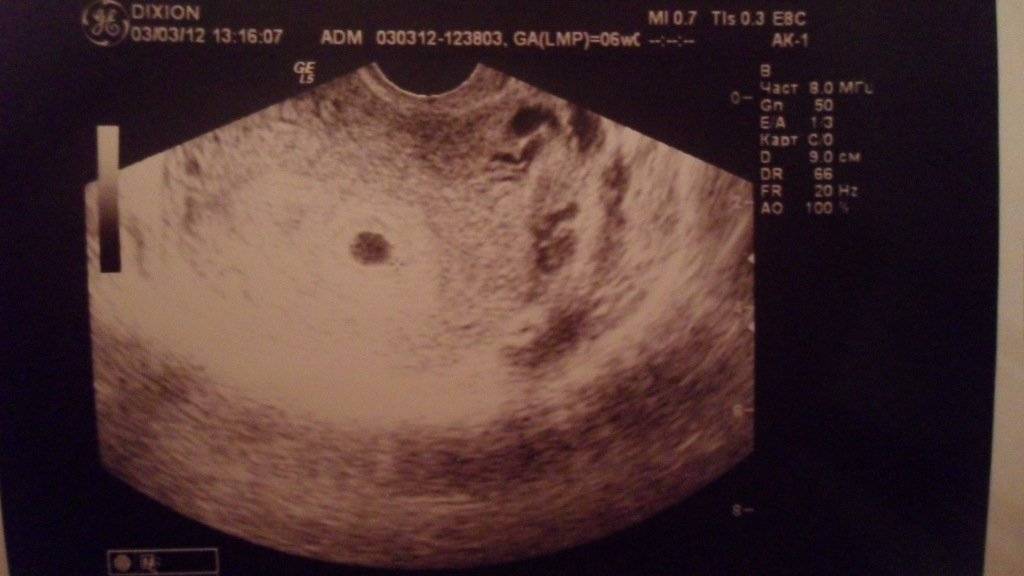 На какой неделе видно эмбрион на узи? плодное яйцо эмбриона на узи