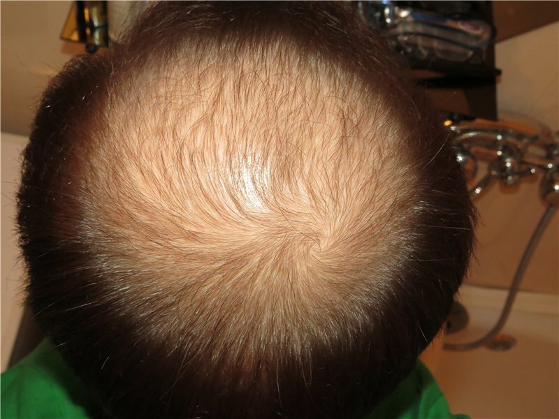 На голове у новорожденного выпадают волосы? без паники!