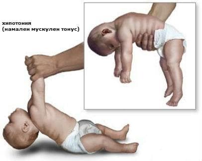 Все о мышечном гипотонусе у младенца: признаки гипотонии у грудничков, массаж