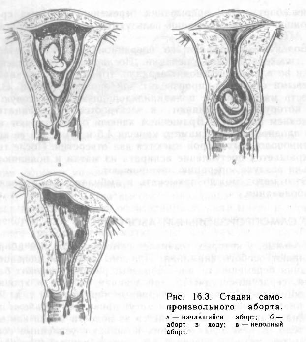 Кольцо на шейку матки при беременности - показания, польза