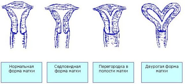 Седловидная матка при беременности: причины, последствия, лечение / mama66.ru