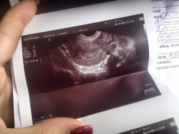 Узи 4 недели беременности от зачатия: можно ли делать, что покажет исследование (фото) и видно ли эмбрион, размеры плода, нормы