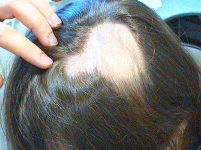 В чем причины выпадения волос у ребенка