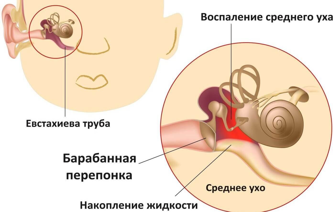 Как понять, что у ребенка болит ухо – симптомы и проявления отита
